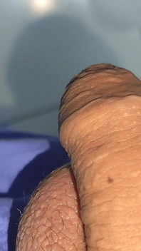Mysterious Solution Inserted Into the Wrinkled Cock.