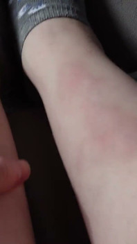 Eu Te Mostro Os Hematomas Nas Minhas Pernas Depois De Sexo