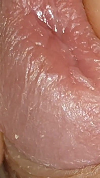 The World's Largest Foreskin Opening and Closing.