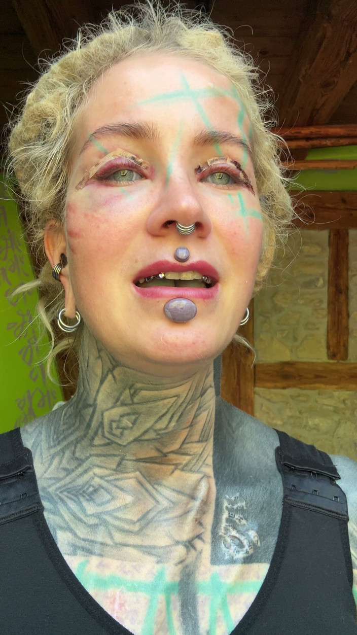 Anuskatzz: Day 3 After My Boobs and Upper Blephoplasty Op