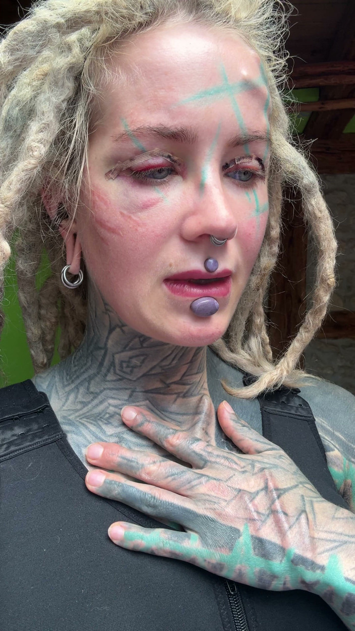 Anuskatzz: This Is Day 4 After My Boobs Surgery and My Body...