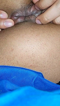 Hemorrhoids in the Ass