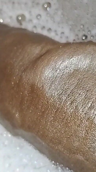 Thick Veins on Cms BBC