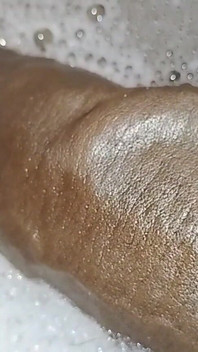 Thick Veins on Cms BBC