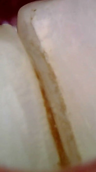 Medical Endoscope Oral Exam: Gummy Chewing, Extreme Teeth & Tongue Macro