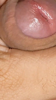 Boy with Large Anal Phimosis Excited!