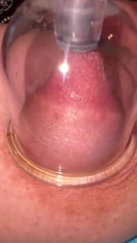 Nipple Cupping Part 2