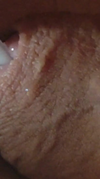 Reuse of Cum Through the Urethral Canal.
