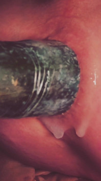 Dilatation Anal