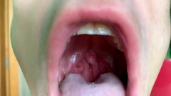 Idmir Sugary: POV s Endoskopem