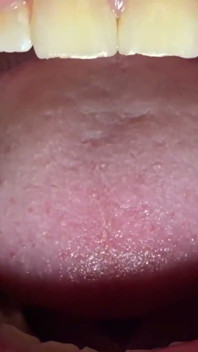 Close-up da boca e amígdalas