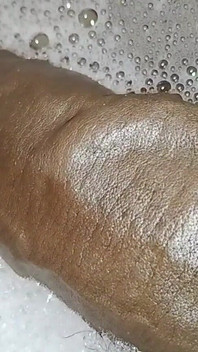 Thick Veins on Cms BBC