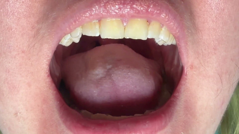Spunk Kip: Mouth &amp; Tonsils Close-up