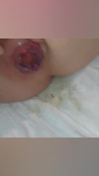 Prolapsed Ass