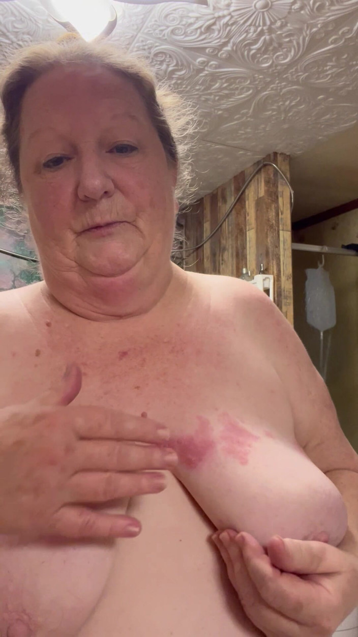 PlayfulRose1: Špatný případ šindele