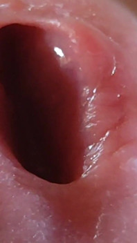 Opening the Scar of the Rough Frenulum!