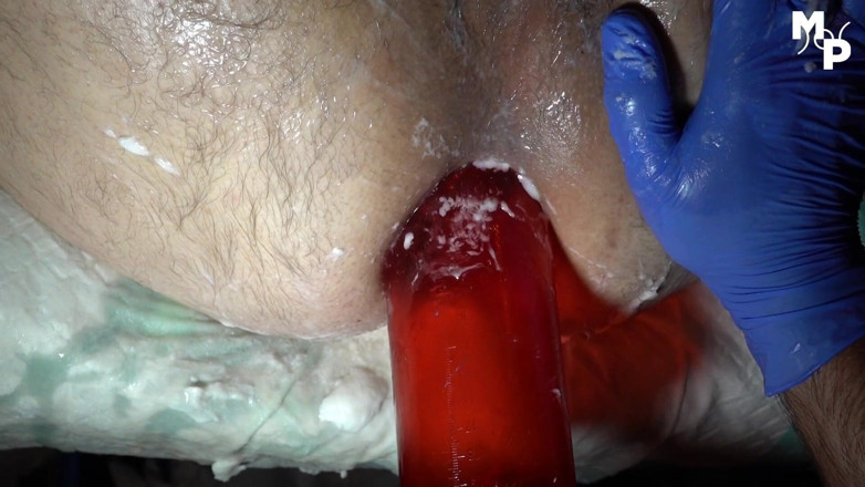 Marcus Pollack Gay: Fisted with rippled gloves and vacuum pumped prolapse