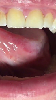 Mouth & Tonsils Close-up