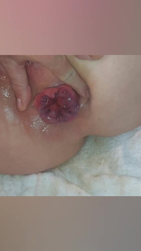 Prolapsed Ass