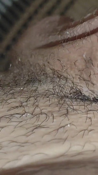 Detaching the Foreskin From the Glans Slowly.