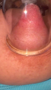 Nipple Cupping Part 2
