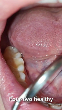 Complete Teeth Exam by the Dentist, Installation of Jewelry