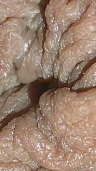 The World's Largest Foreskin Opening and Closing.
