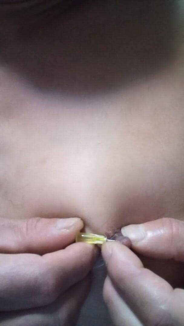 Osiritikubi: Niple needle