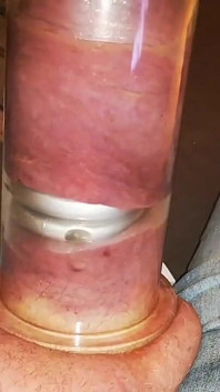 Sebelum dicrot ekstrem