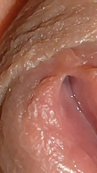 The World's Largest Foreskin Opening and Closing.
