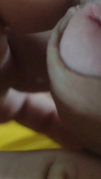 Scarred Frenulum Causes Glans Erection!