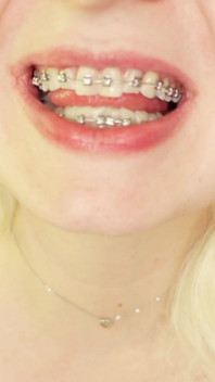 Eating in Braces, Food Fetish Video Devour