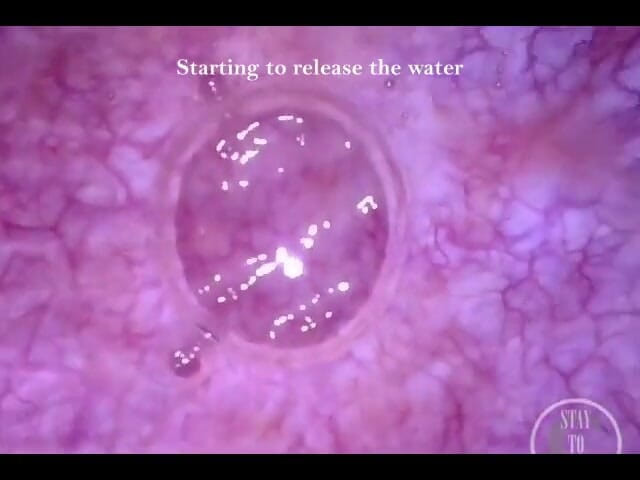 Lina Free: POV endoskop inflace močového měchýře v katétru!