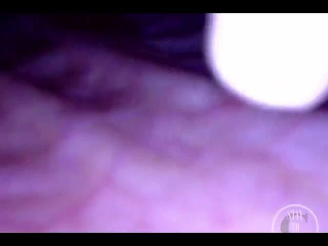 Lina Free: PoV endoscopio catetere inflazione!