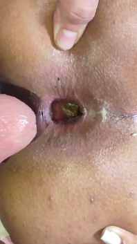 Ils ont coincé leur bite dans mon anus au début de l’année
