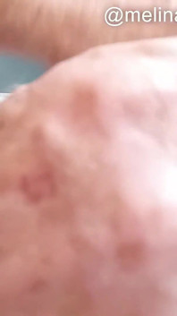 Anal cilalama