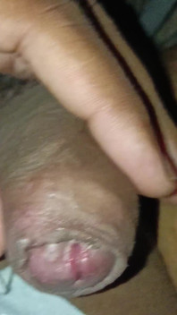 Urine Infection