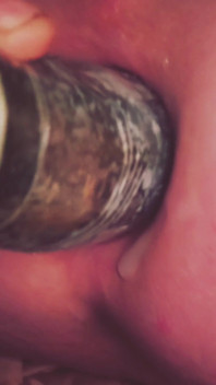 Dilatation Anal