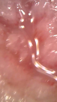 Medisch Endoscoop Mondeling Onderzoek: Gummy Kauwen, Extreme Tanden & Tongmacro