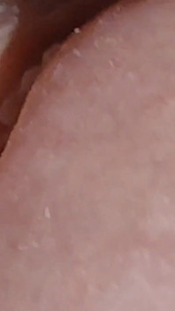 Enlargement of the Deep Urethral Hole!!