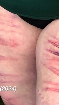 Nichole Thorne, double pénétration de la cuisse et coups de canne judiciaires