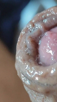 Deep Split in the Glans Produces Bubbling Liquid