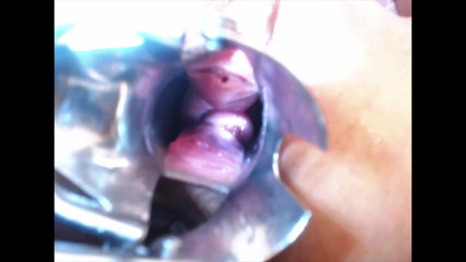 Littlesubgirl: Speculum Cervix & Anal Exam Great View Inside