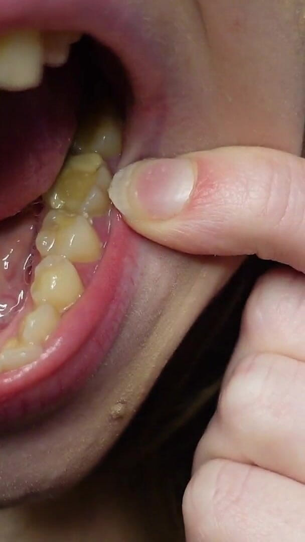 HotRedWildcat: Te Cuento Sobre Los Rellenos En Mis Dientes Y Las...