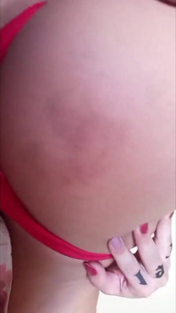 My Butt Cheek Got Purple From a Spanking