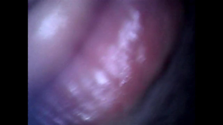 Idmir Sugary: Détails sur l’endoscope - un prépuce de la bite s’enfile un...