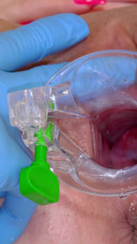 Silicone Sex Bomb Gets Treatment for Her Irritated Cervix