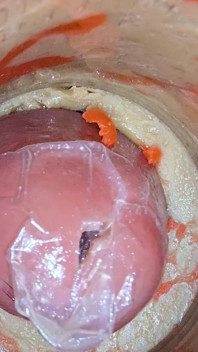 The Camera 4K Inside the Deep Pussy Records a Huge Ejaculation with a Stuck Condom