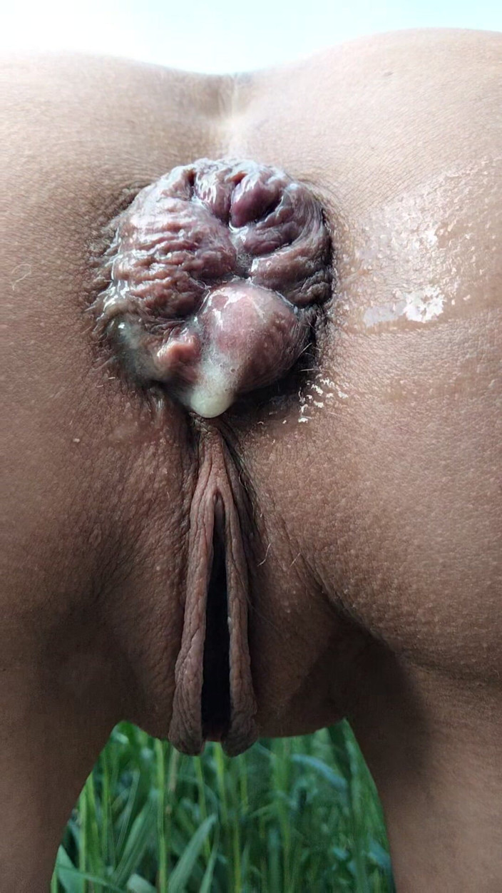 Nadin: 肛门和脱垂