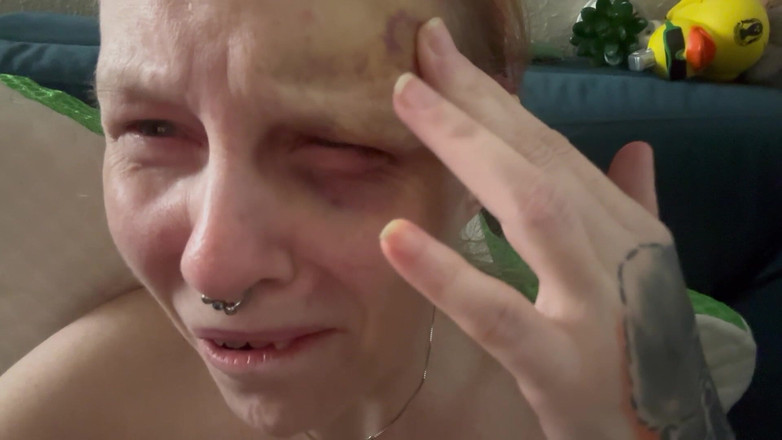 Hot potato girl: Fero il mio proprio livido